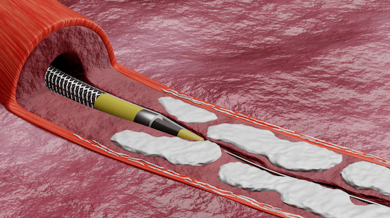 Illustrated image demonstrating how the Shockwave Javelin Peripheral IVL Catheter is delivered to a calcified lesion within the vasculature, without the need for a balloon or inflation