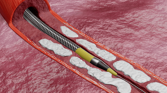 Illustrated image demonstrating how the Shockwave Javelin Peripheral IVL Catheter advances through the vasculature and crosses a previously uncrossable calcified lesion