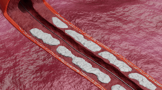 Illustrated image demonstrating how the Shockwave Javelin Peripheral IVL Catheter creates a lumen within the vasculature to enable therapy